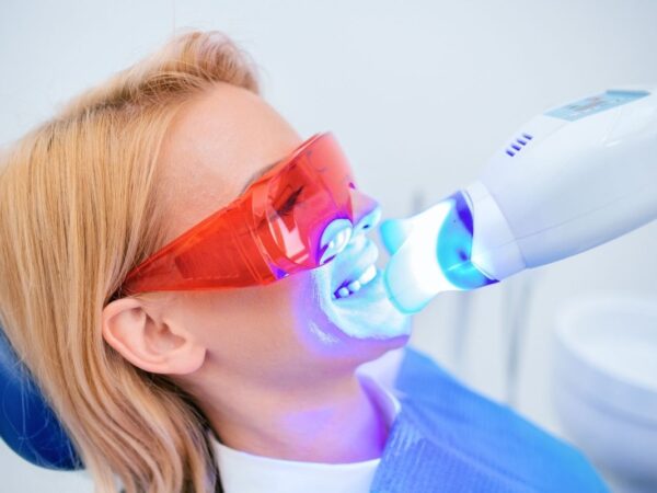 LED lámpás fogfehérítés a Hollán Dentnél